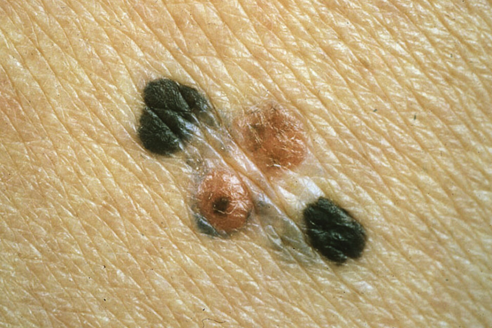 Är du oroligt för att du drabbats av hudcancer? Gå och kolla hudförändringarna hos sjukvården, träffsäkerheten hos hudcancerappar är låg, enligt brittiska forskare. Arkivbild.