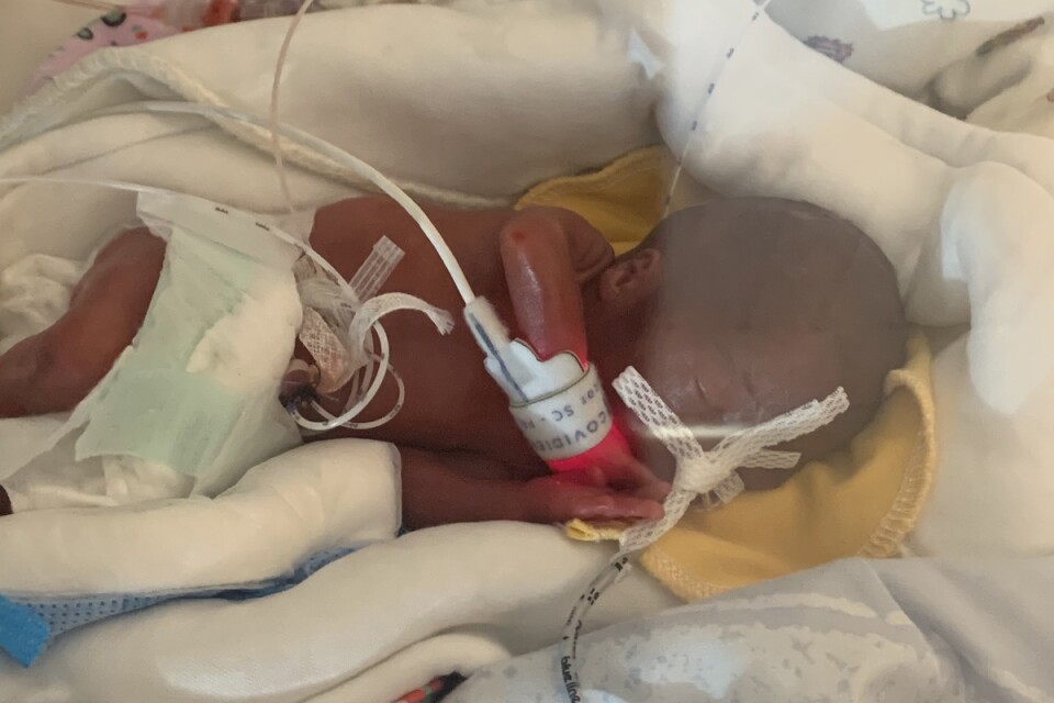 Här är mirakelbebisen Melek kort efter att hon föddes.