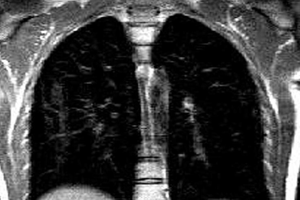 Med hjälp av ädelgasen xenon och en vanlig magnetresonanskamera (bilden), har brittiska forskare upptäckt lungskador hos patienter med långvariga symtom efter covid-19, skador som inte gått att upptäcka med konventionella metoder.