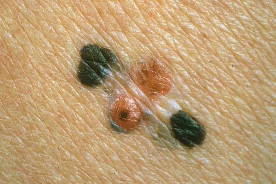 Malignt melanom är en av de cancerformer som ökar.