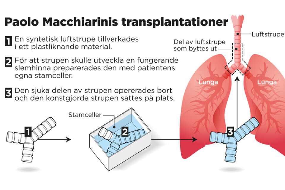 Så gick transplantationerna med syntetiska luftstrupar till.