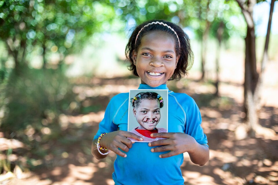 Clara, 11 år, före och efter operation. Uppdrag i Antsirabe, Madagaskar 2019.
