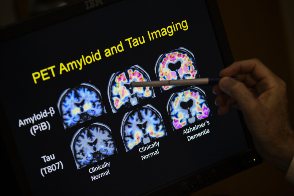 Personer med Alzheimers sjukdom kan identifieras innan de har några symtom, visar en stor internationell studie. Arkivbild.