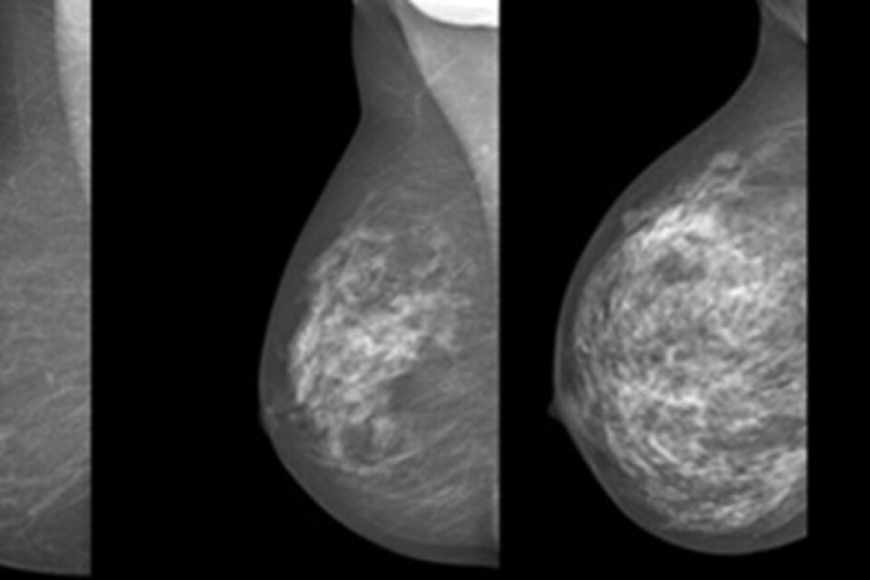 Mammografibilder på bröst med olika grad av täthet. Det vitaste bröstet längst till höger har högst täthet.