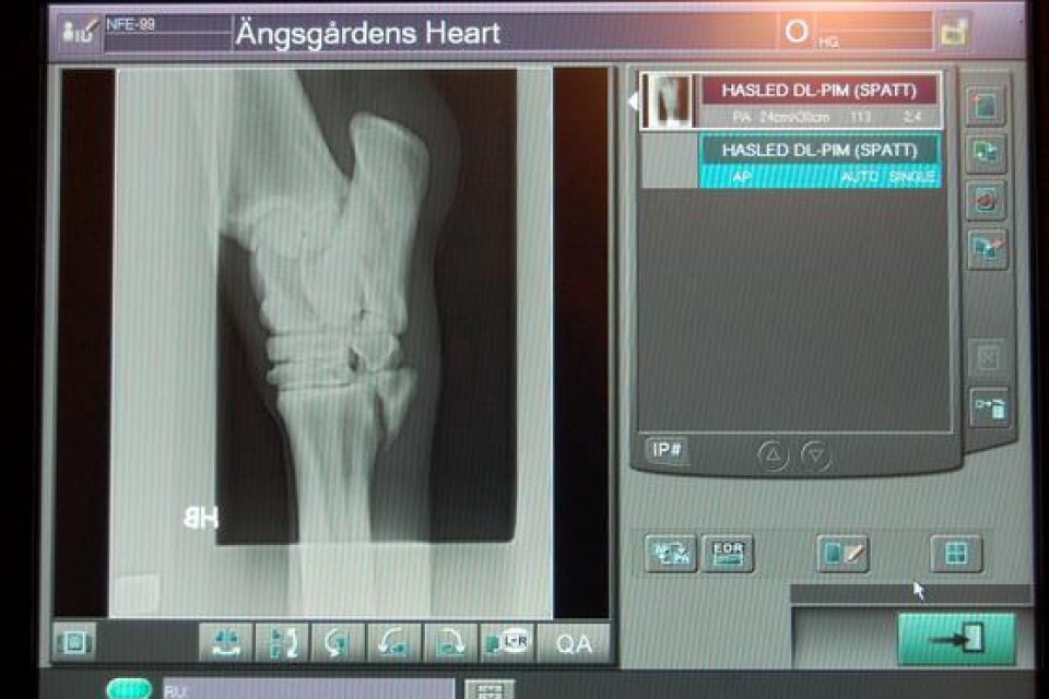 På röntgenbilderna syns resterna av griffelbenet, den lilla trekantiga biten till vänster.