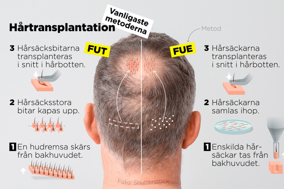 De vanligaste metoderna för hårtransplantation, FUT och FUE.