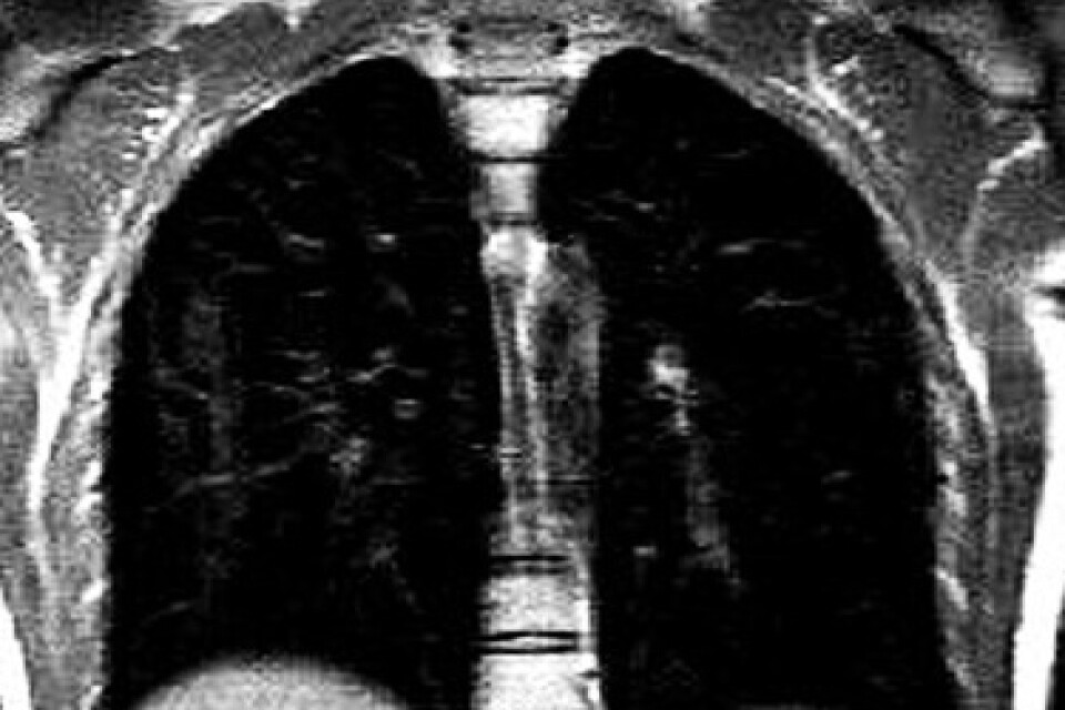 Med hjälp av ädelgasen xenon och en vanlig magnetresonanskamera (bilden), har brittiska forskare upptäckt lungskador hos patienter med långvariga symtom efter covid-19, skador som inte gått att upptäcka med konventionella metoder.