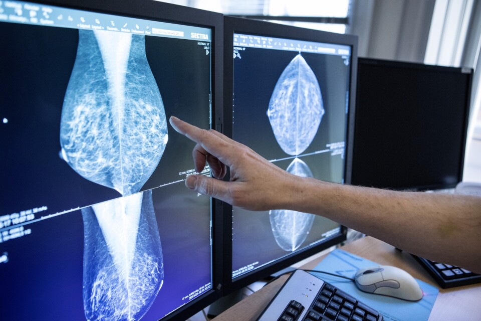 STOCKHOLM 20170217
En läkare tittar på bröströntgenbilder, mammografibilder.
Foto: Christine Olsson / TT / Kod 10430